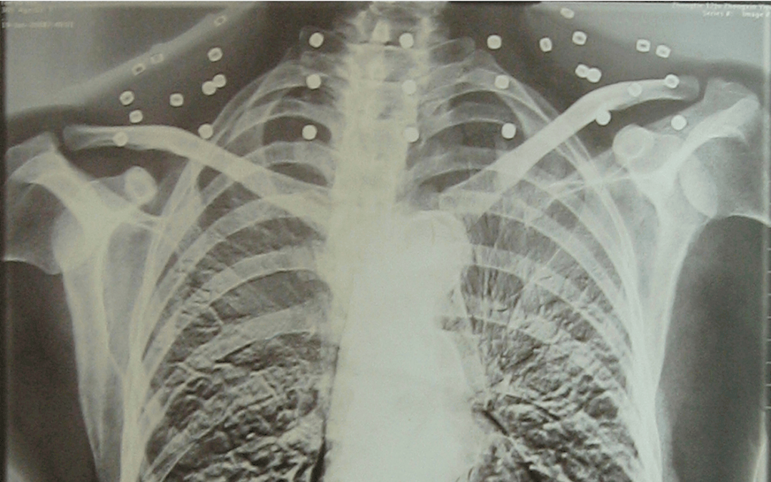 皇冠信用盘可以占几成
_“老先生皇冠信用盘可以占几成
，您把项链取下来再做CT”